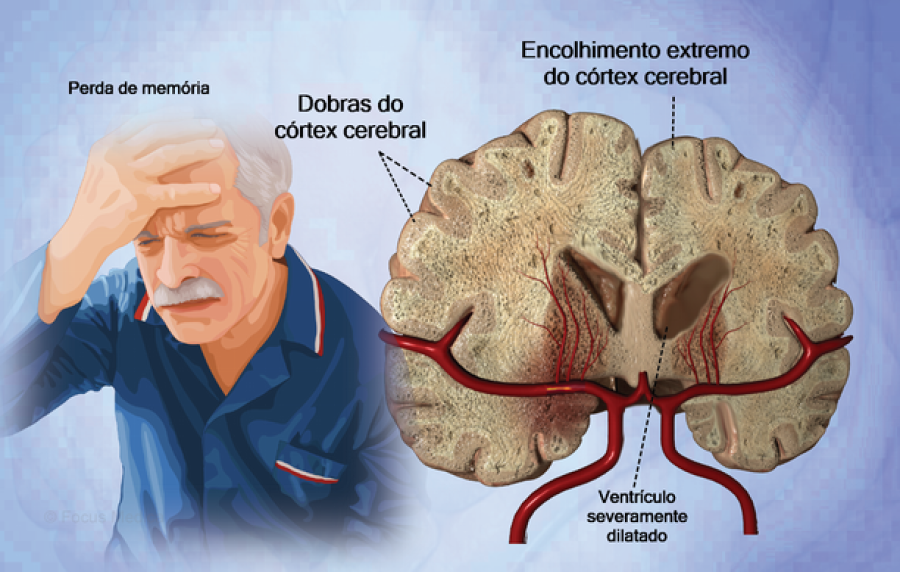 Grupo de sintomas que afeta a memória e o pensamento e interfere na vida diária.